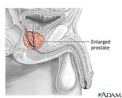 knuser steinen i nyrebekken eller urinveier. Forebyggende behandling for å unngå nye nyresteiner. Benign prostatahyperplasi - Side 130 Godartet forstørrelse (hyperplasi) av prostata.