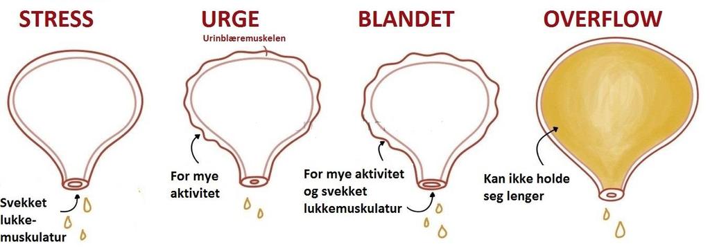 Rammer flest kvinner i høy alder Flere