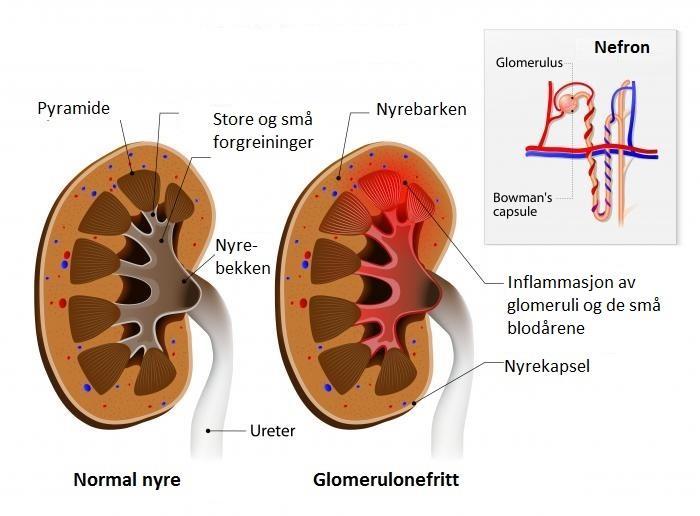 Glomerulonefritt - Side 121 Betennelse i nyrens karnøster (glomeruli).