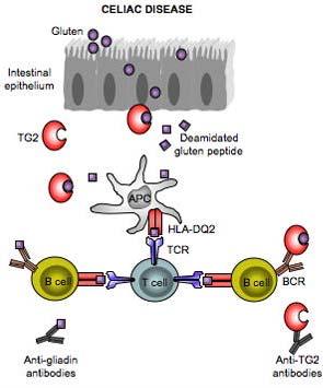 Brudd på toleranse ved utvikling av cøliaki I Gluten spaltes av enzymet vevstransglutaminase (ttg) Glutamin residuer i gluten peptider deamideres til glutamat som øker deres