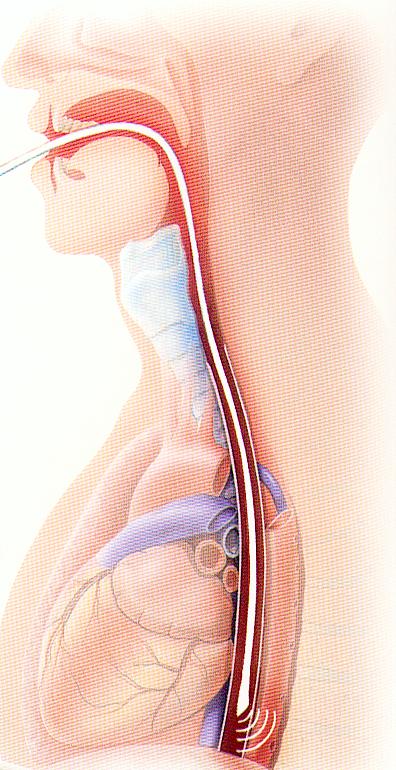 Øsofagusdoppler Øsofagusdoppler Relativt tynn og elastisk slange med en