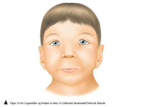 Motstridende data Leppe-kjeve-ganespalte? FAS-liknende syndrom?