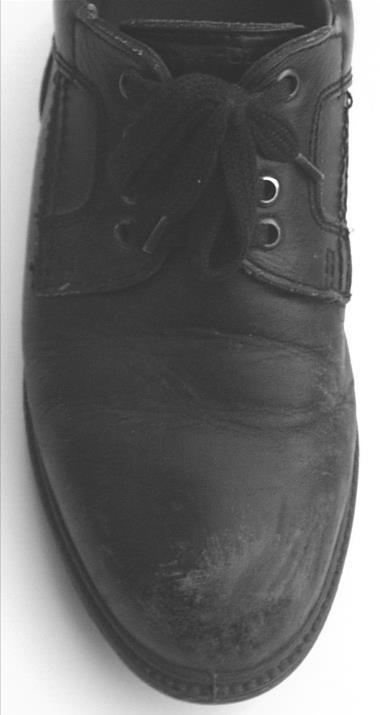 8.1.4 Spissing på skoen. Spissing på skoen. Spissingen på skoen har stor betydning for stillingen til forfoten, og avviklingsmønsteret i gangavviklingen.
