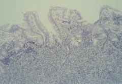 Svulst Translokasjon Involvert gen Ewings sarkom t(11;22)(q24;q12) t(21;22)(q22;q12) t(7;22)(p22;q12) FLI1-EWS ERG-EWS ETV1-EWS Synovialt sarkom t(x;18)(p11;q11) SSX-SYT Desmoplastisk småcellet