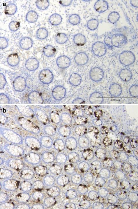 Chromogranin in lymphocytic colitis High density of CgA positive cells in