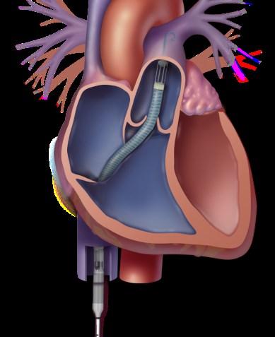 Impella RP Høyre ventrikkel svikt Post TX Post VSD lukning Post LVAD CO: 4.