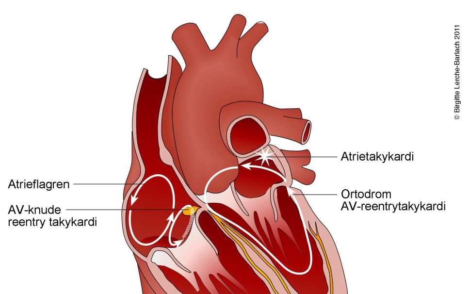 SVT AV nodal reentrant