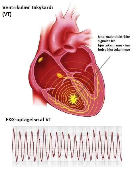 Mekanismer Reversible årsaker Ischemi Infeksjon Metabolisme/elektrolytter forstyrelser Andre Genmutasjon Kanalopati (Lang QT syndrom/tdp, Brugada syndrom, Catecholaminergic polymorphic VT) Arr i