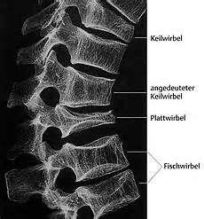 VERTEBRALE BRUDD Predikerer flere brudd (alle typer) Melton LJ et al.