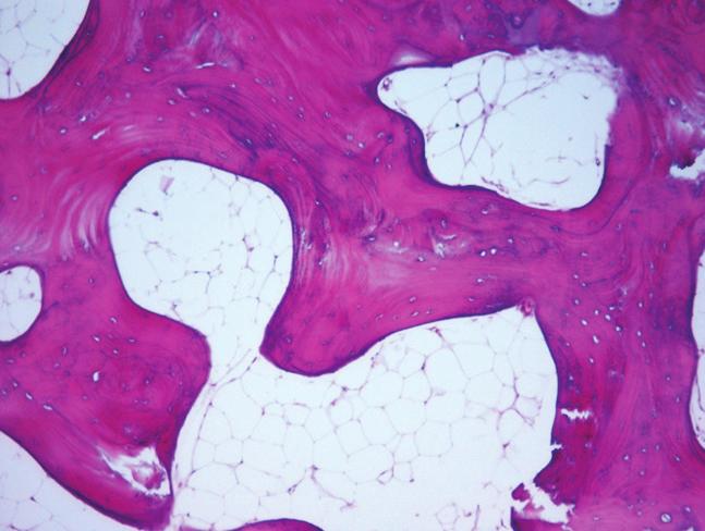 374 kreftsykdommer Figur 2.13.2 Til venstre: normalt benvev med benbjelker med parallellfibret benvev og små, regelmessige osteocytter. Mellom benbjelkene sees fettmarg. Til høyre: osteogent sarcom.