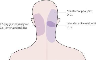 Trigeminocervical nucleus Strukturer innervert fra c1 - c3