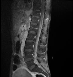 INTRADURALE EKSTRAMEDULLÆRE TUMORES meningeal carcinomatose