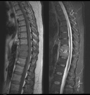 SPONDYLODISKITT radiologisk diagnostikk MR er gullstandard i den radiologiske diagnostikken: