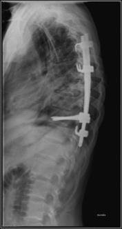 SPONDYLODISKITT sekveler Mange pasienter opplever langvarige smerter i etterkant.