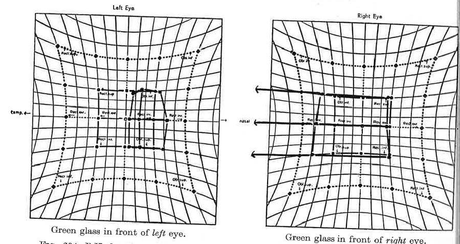 Hessplott Duanes vø, type 1 (Hubers klassifisering). Hentet fra Practical Orthopticcs in the treatment of squint, fifth ed. K.Lyle and K.C.Wybar Vi ser her et esoavvik på det affekterte venstre øyet.