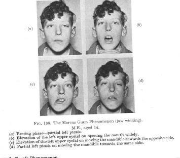 Marcus Gunn jaw winking fenomen Hentet fra Practical Orthopticcs in the treatment of squint, fifth ed. K.Lyle and K.C.Wybar Medfødt tilstand. Autosomal dominant, ufullstendig penetrans.