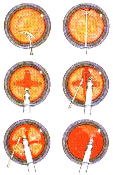 Phacoemulsification 1. Capsulorrhexis 2. Hydrodissection 3. Sculpting of nucleus 4.