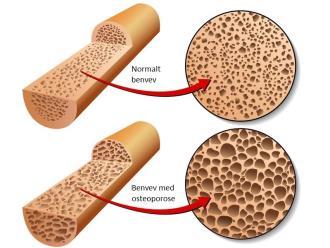 Binyrebarksvikt / Addisons sykdom ikke eksamensstoff Binyrebarksvikt er en tilstand der binyrebarken skiller ut for lite hormoner. Addisons sykdom er binyresvikt som skyldes sykdom i binyrebarken.