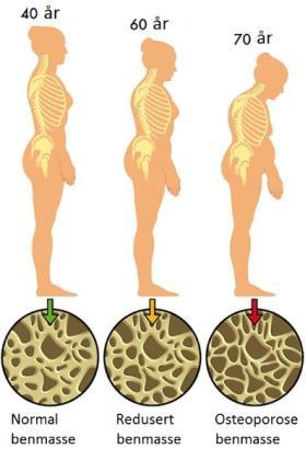 Huden blir brunfarget, særlig på steder utsatt for lys og på steder med trykk (av f.eks. bukseseler, brystholder). Blodtrykket blir lavt. Osteoporose Bind 1 side 236-237 Økt porøsitet i knoklene.