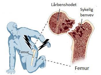 Osteoporose, forts.