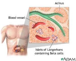 type I Autoimmun sykdom der immunsystemet angriper og ødelegger de insulin-produserende cellene i bukspyttkjertelen.