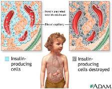 Symptomer og tegn (uoppdaget diabetes type I) Symptomer som skyldes at cellene ikke får tatt opp glukose og bygget opp energilagre: Vekttap Redusert