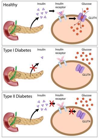 Diabetes mellitus type II Diabetes type II skyldes ofte en kombinasjon av: Redusert insulinproduksjon i