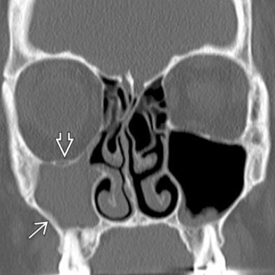 utvikle KS Retensjonscyste Silent sinus Bilder fra