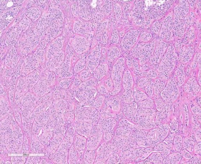 Høyt differensierte NET Histologi Celler som minner om