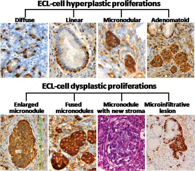 Høyt differensierte NET Magesekk NET type 1 og 2 vanligst: Hypergastrinemi: Trofisk effekt på ECL-cellene hyperplasi dysplasi/mikro-net (>150 µm) >0,5 mm = NET Viktig å finne årsak til