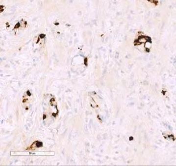 Kromogranin A CDX2 Adenokarsinom ex begercellekarsinoid Områder med markert