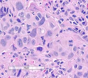 organoid Moderat til rikelig eosinofilt