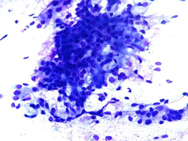 Malign spyttkjerteltumor del 2 Februar 2018 Mucoepidermoid carcinoma Def: (WHO 2017)