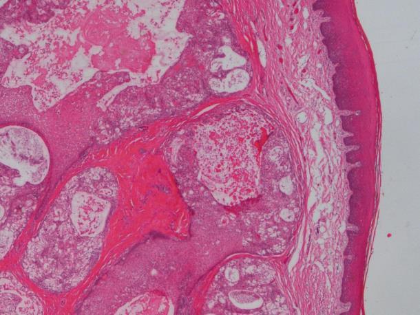 of mucinous, intermediate (clear-), and squamoid tumor cells forming cystic and