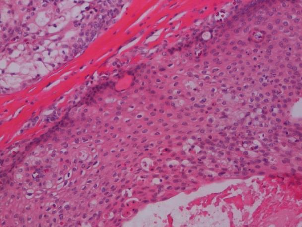 Karsinom ex Pleomorft Adenom WHO 2017 Carcinoma ex pleomorphic