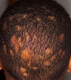 Behandling tinea capitis: