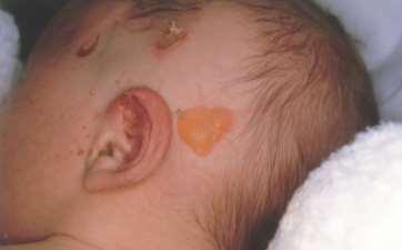 Medfødte tilstander Epidermolysis bullosa