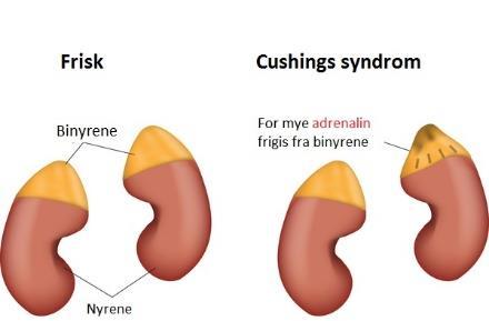 Cushings syndrom Bind 1 side 188-189 Forårsakes av økt konsentrasjon av glukokortikoider (kortisol). To hovedårsaker Langvarig behandling med glukokortikoider (kortison).