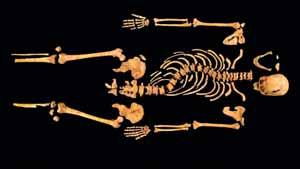 AKTUELT Diagnose: skoliose Etter drøye 500 år i bakken under det som dag er en parkeringsplass i Leicester, har arkeologer funnet levningene av Richard III, konge av England fra 1483-85.