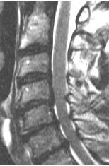 Når bruke betegnelsen spinal stenose?