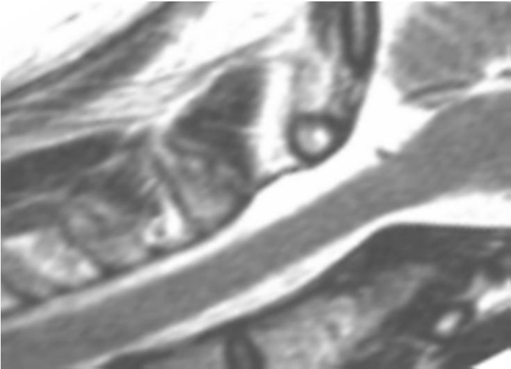 Cervical myelografi Bukleie med ekstendert nakke