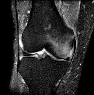 Ahlback's disease Egentlig / ofte  cor