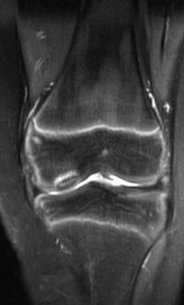 Kne>ankel>albu Repetetiv trauma