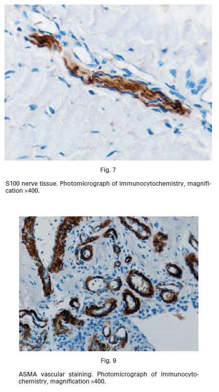 Inflammasjon og immunrespons Økt antall immunceller B- og T-lymfocyter, macrofager Økt mengde Inflammatoriske