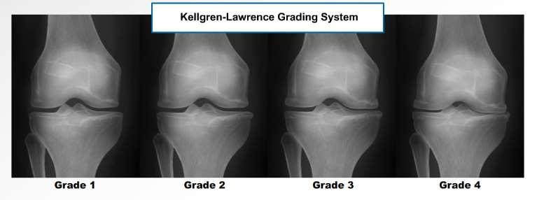 Joint space Osteophyte/other Slight narrowing Distinct narrowing Severe structural Bone cysts, sclerosis