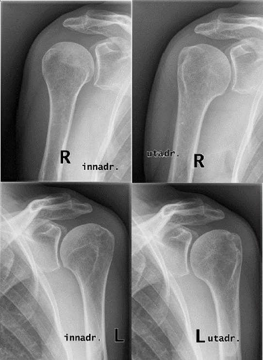 Classification of radiological OA The Samilson-Prieto