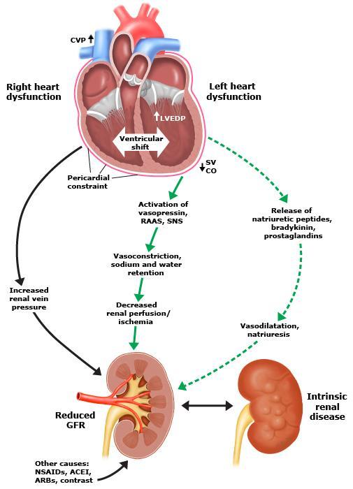 Patofysiologi og mekanismer Nevrohumoral adaptasjon Redusert nyreperfusjon SNS, RAAS, vasopr., endoth. Salt og vannretensjon Som resultat av bl.a. CO Økt trykk i nyrevener Økt abd.