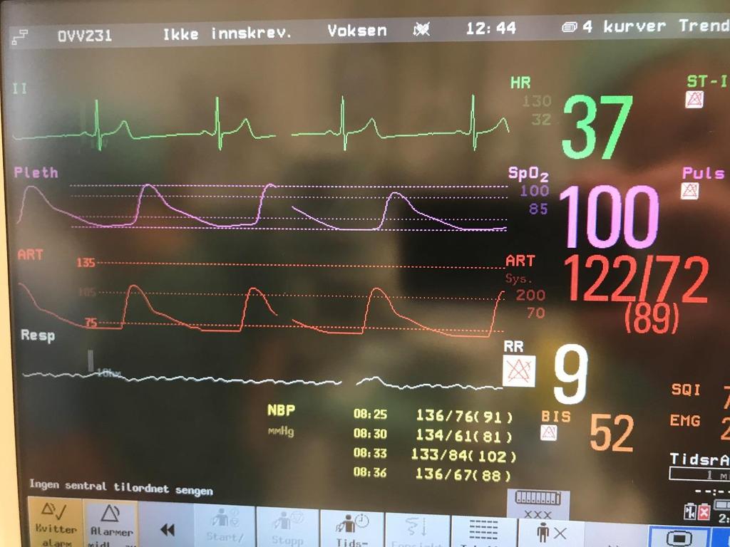 Optimalt blodtrykk er 150-160mmHg peroparativt, men justeres individuelt Risiko for cerebrale