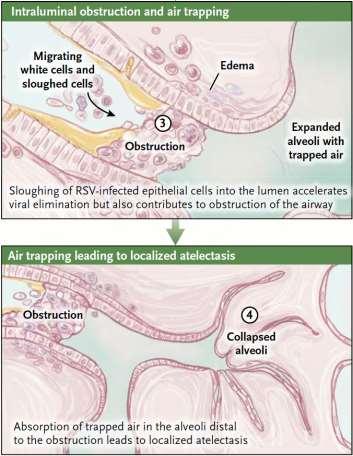 Bronkiolitt Pasienten får så delvis eller hel obstruksjon av luftstrøm, distal luftopphopning, atelektase, og ventilasjon/perforasjon uoverensstemmelse
