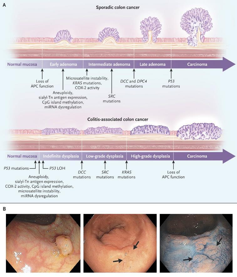 Chronic inflammation is assumed to underlie the cause of colitis-associated cancer, with oxidative stress induced DNA damage resulting in the activation of procarcinogenic genes and silencing of